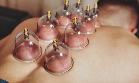 Cupping Massage Therapy